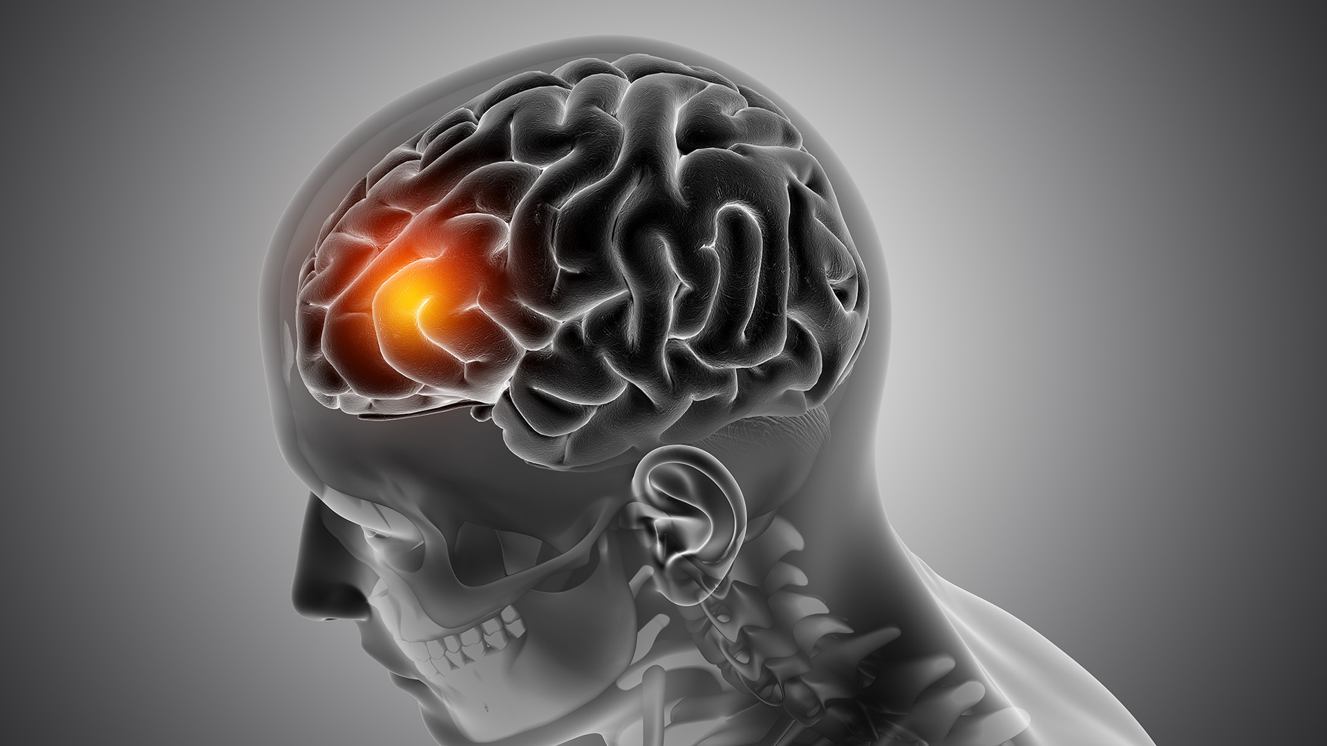 What is BRAIN TUMOR