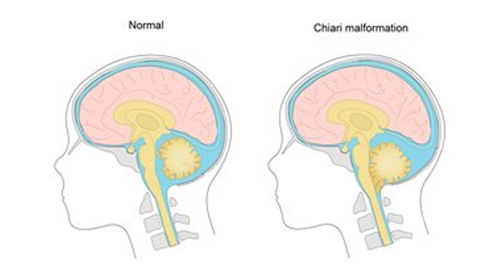 What Is Chiari Malformations?
