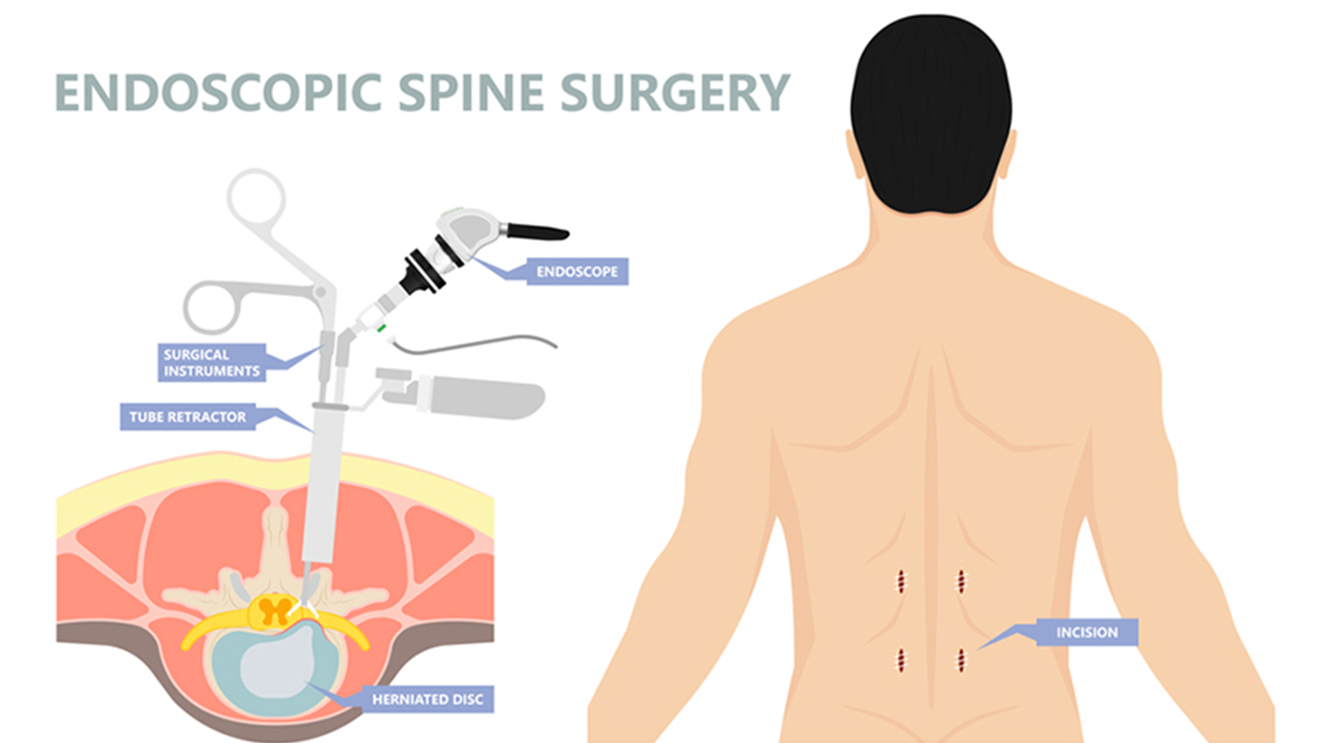 What Is Endoscopic Spine Surgery (KeyHole Surgery)?