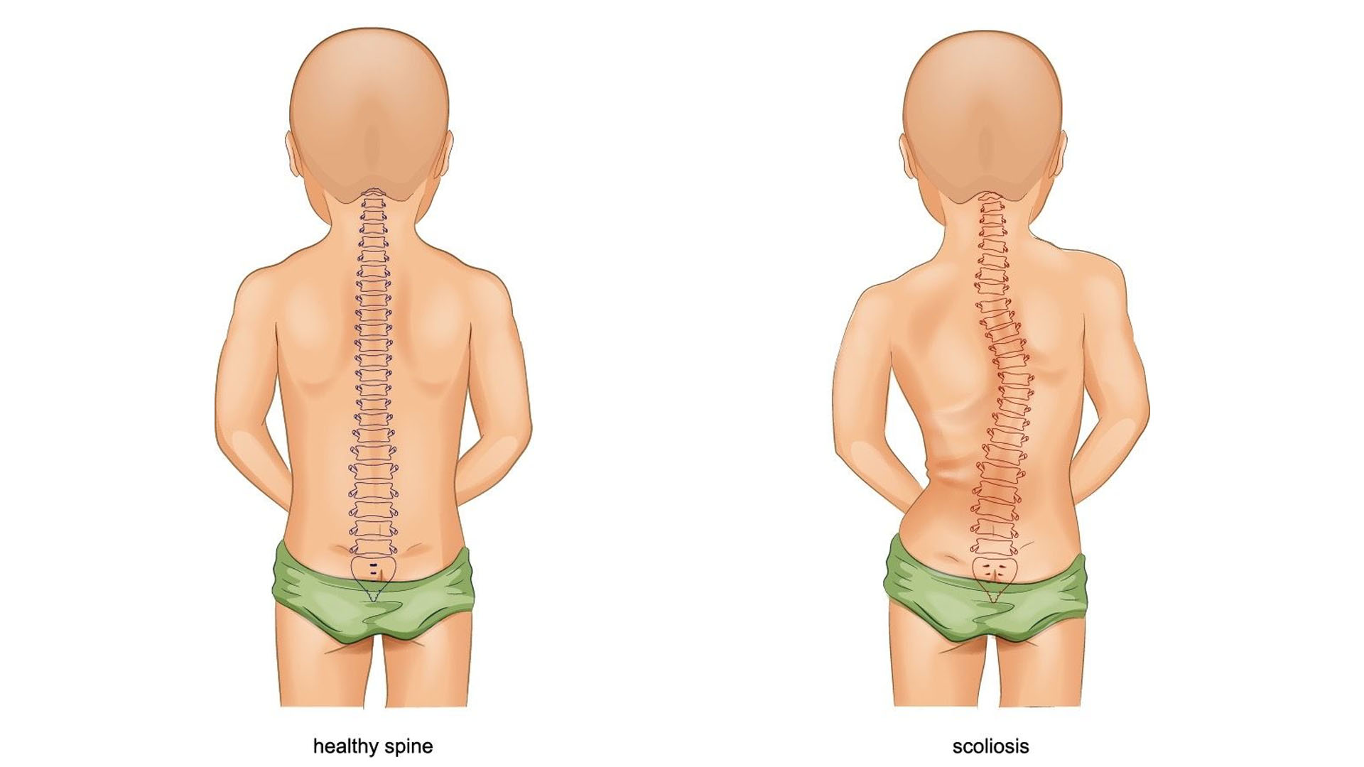 Why do the children happen to be at high risk for Scoliosis?