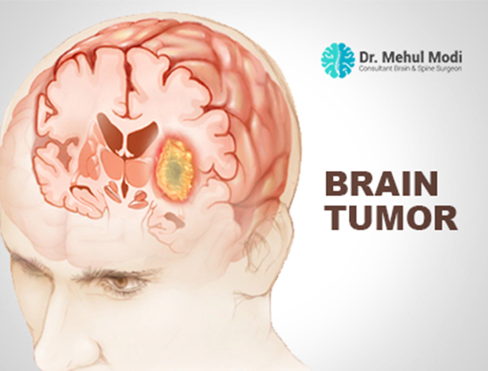 Neuro-oncology(Brain tumors)